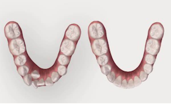 矯正完了までの歯の移動が術前に確認できる